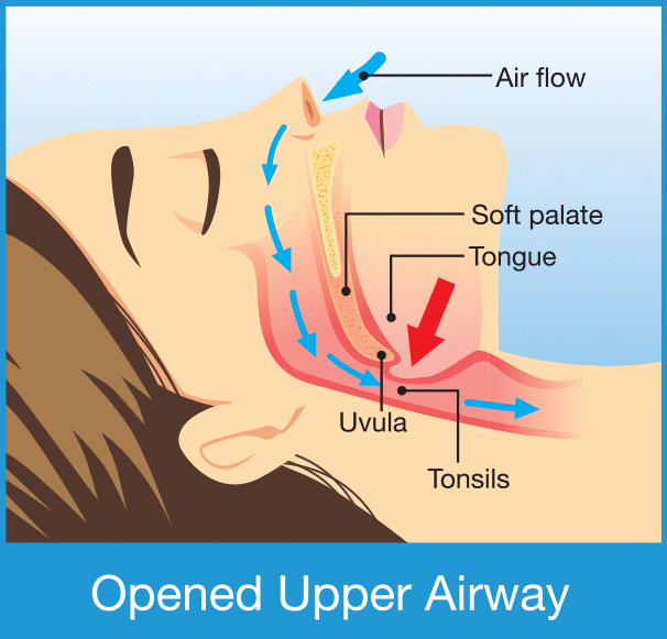 Snoring Types Snoring – Sydney Sleep